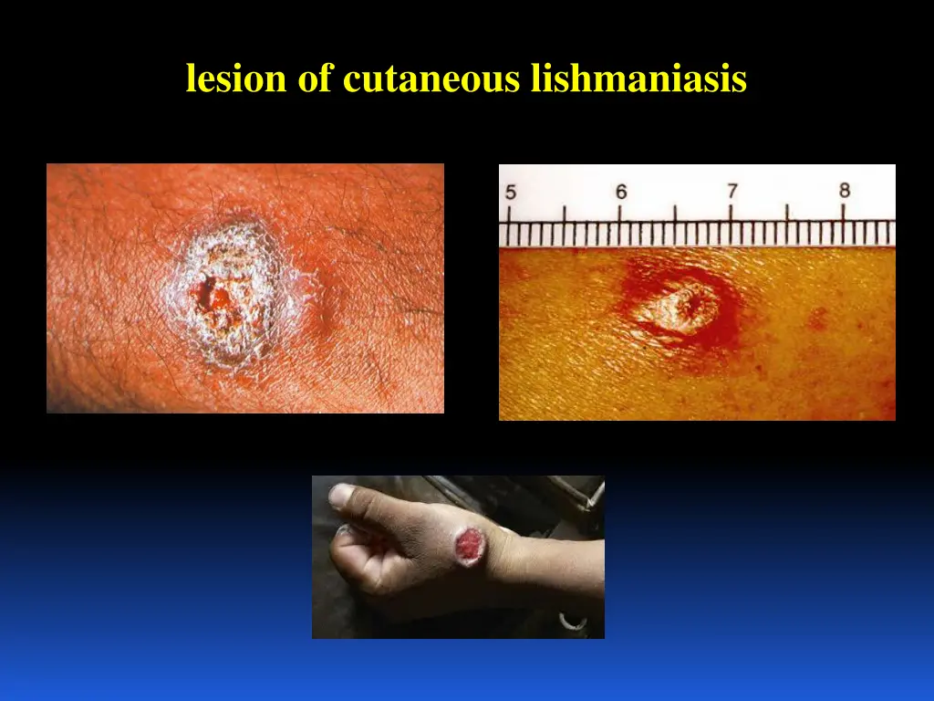 lesion of cutaneous lishmaniasis