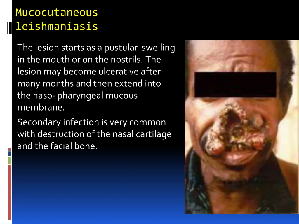 mucocutaneous leishmaniasis