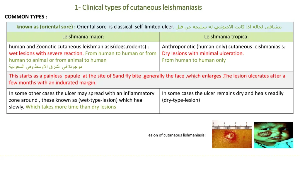 1 1 clinical types of cutaneous leishmaniasis