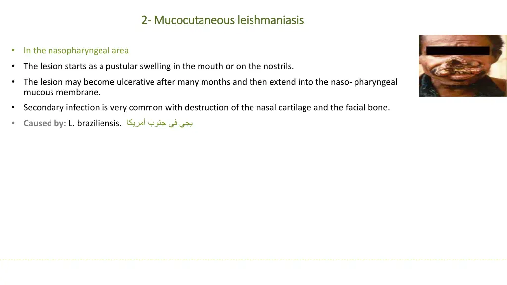 2 2 mucocutaneous leishmaniasis mucocutaneous