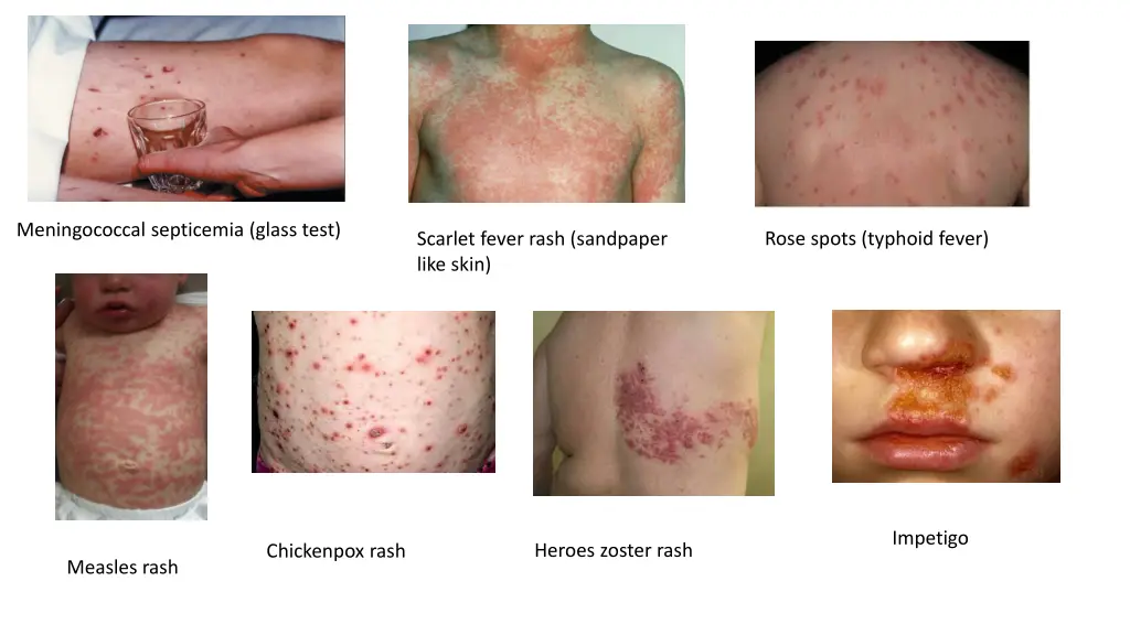 meningococcal septicemia glass test