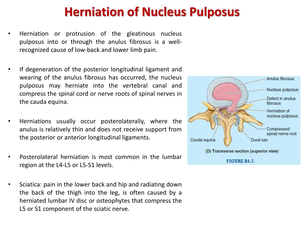 herniation of nucleus pulposus