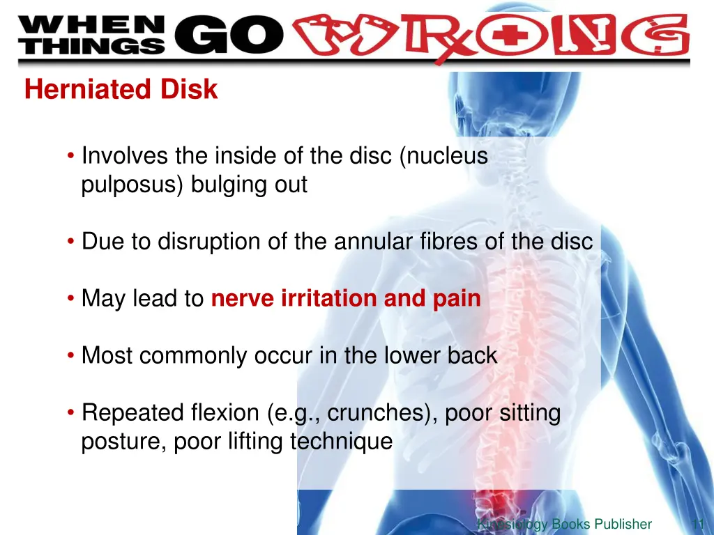 herniated disk