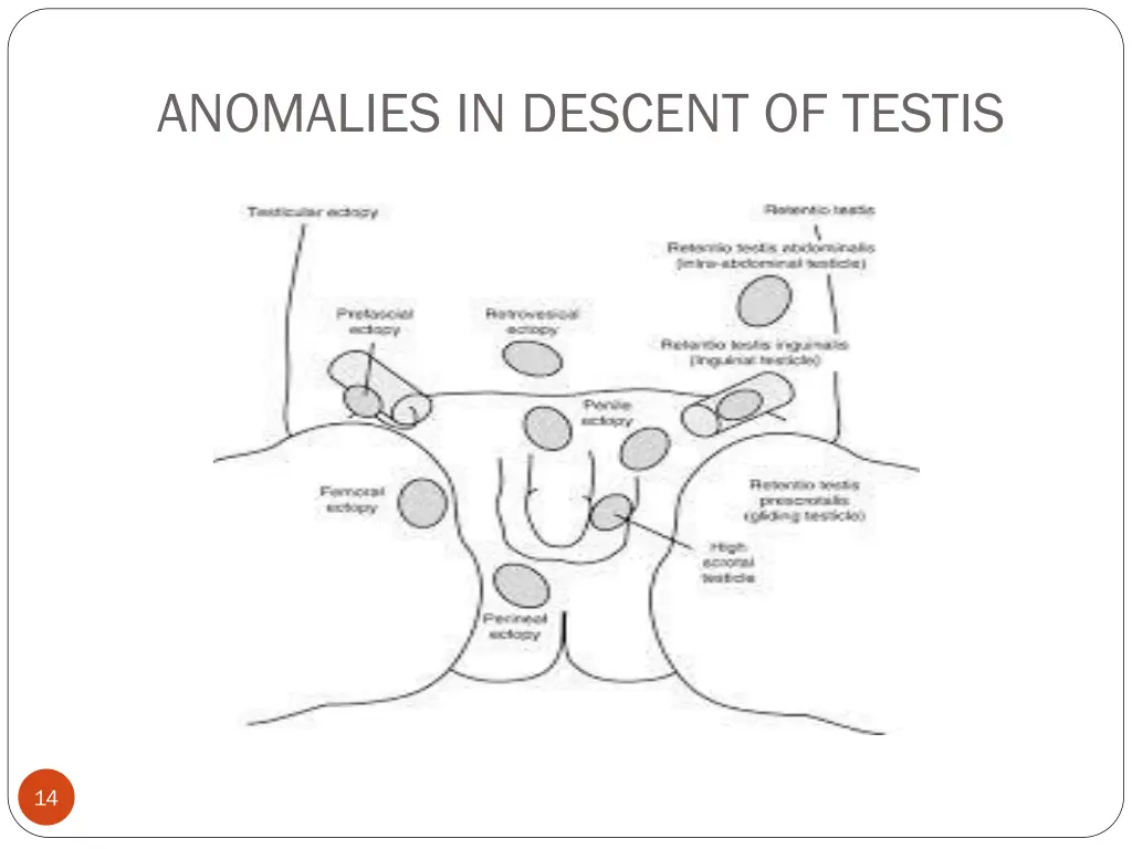 anomalies in descent of testis