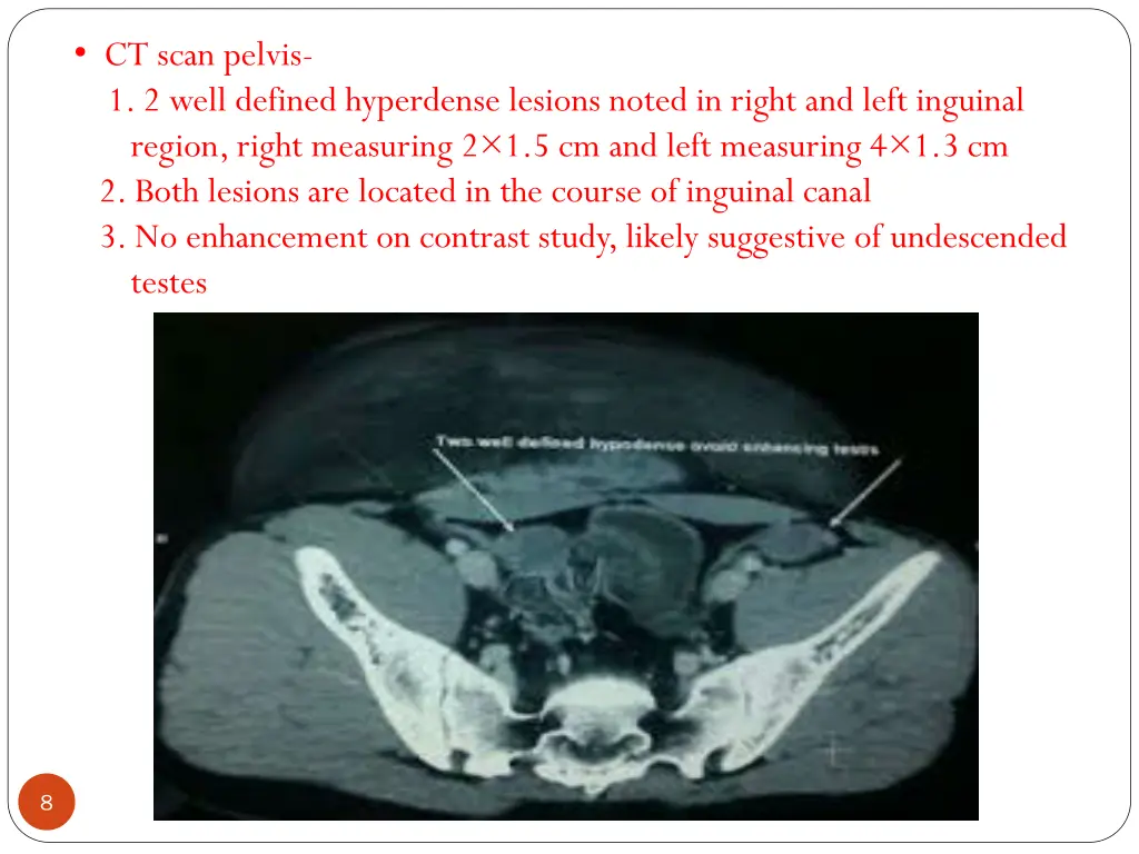 ct scan pelvis 1 2 well defined hyperdense