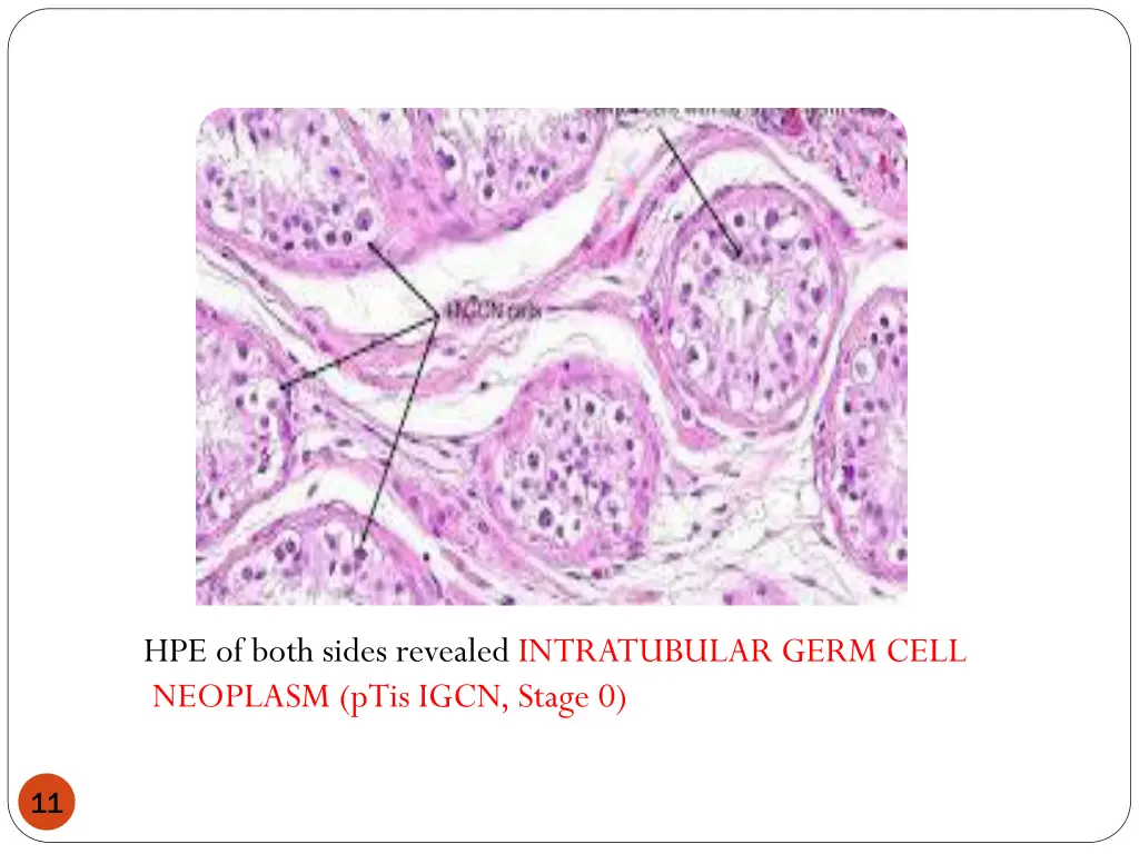 hpe of both sides revealed intratubular germ cell