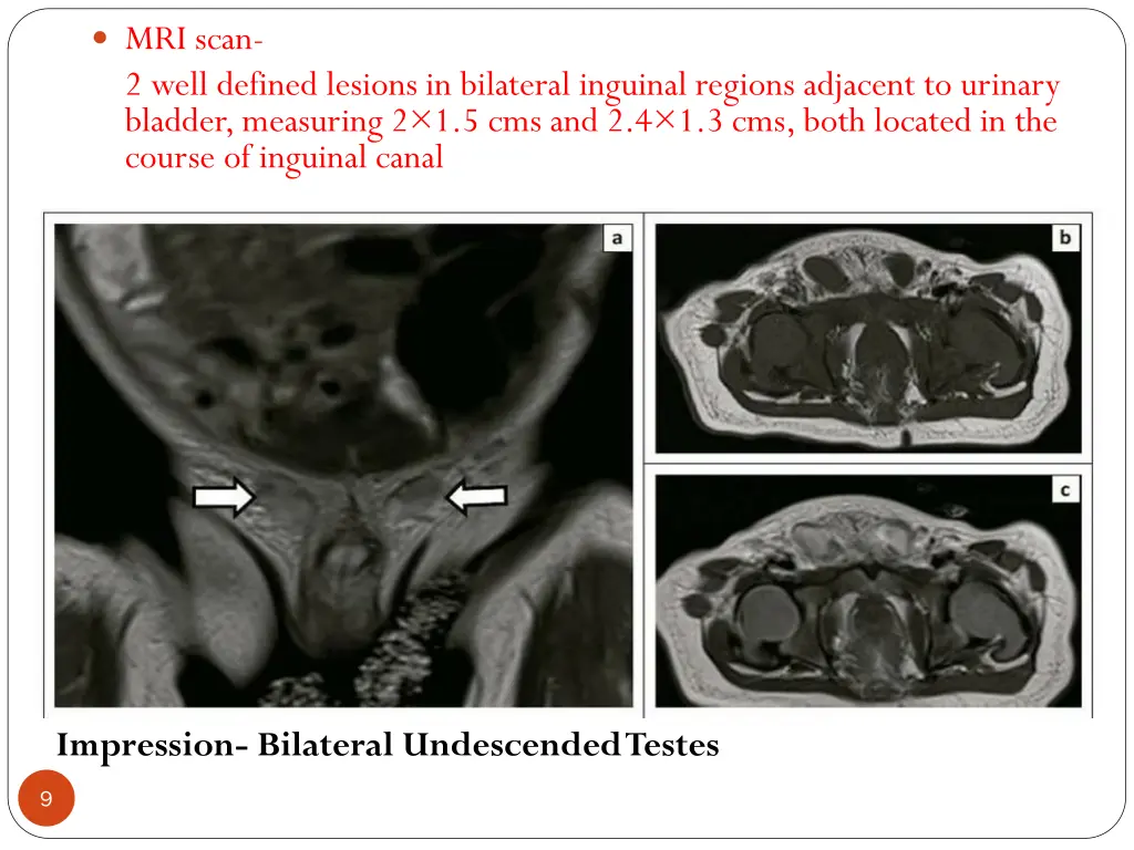 mri scan 2 well defined lesions in bilateral