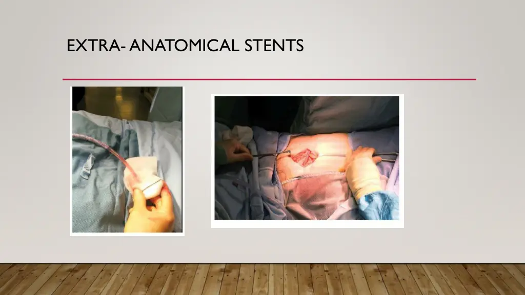 extra anatomical stents 1