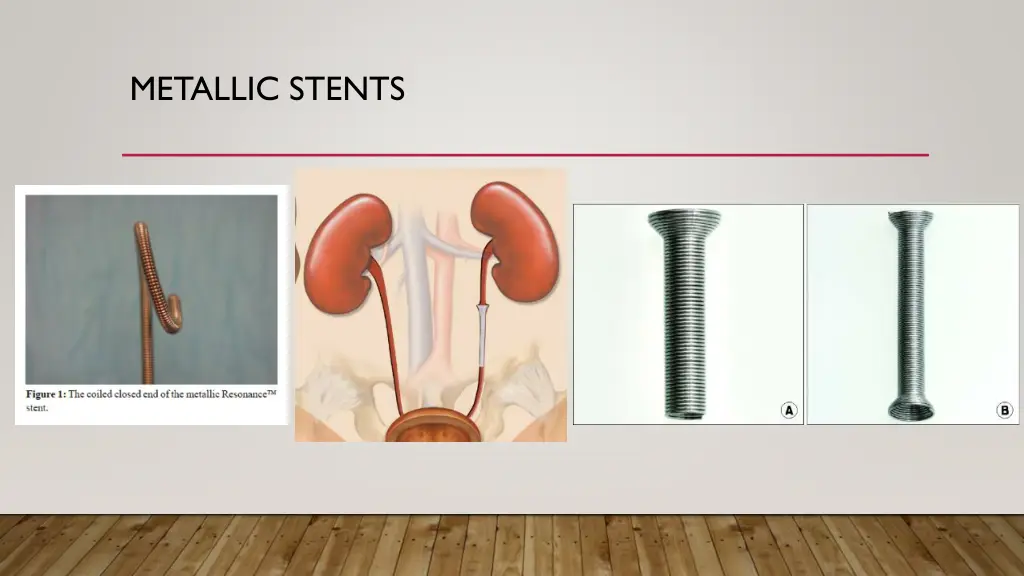 metallic stents 1