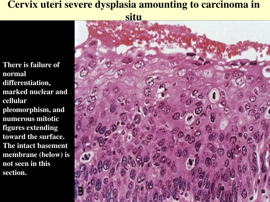 cervix uteri severe dysplasia amounting