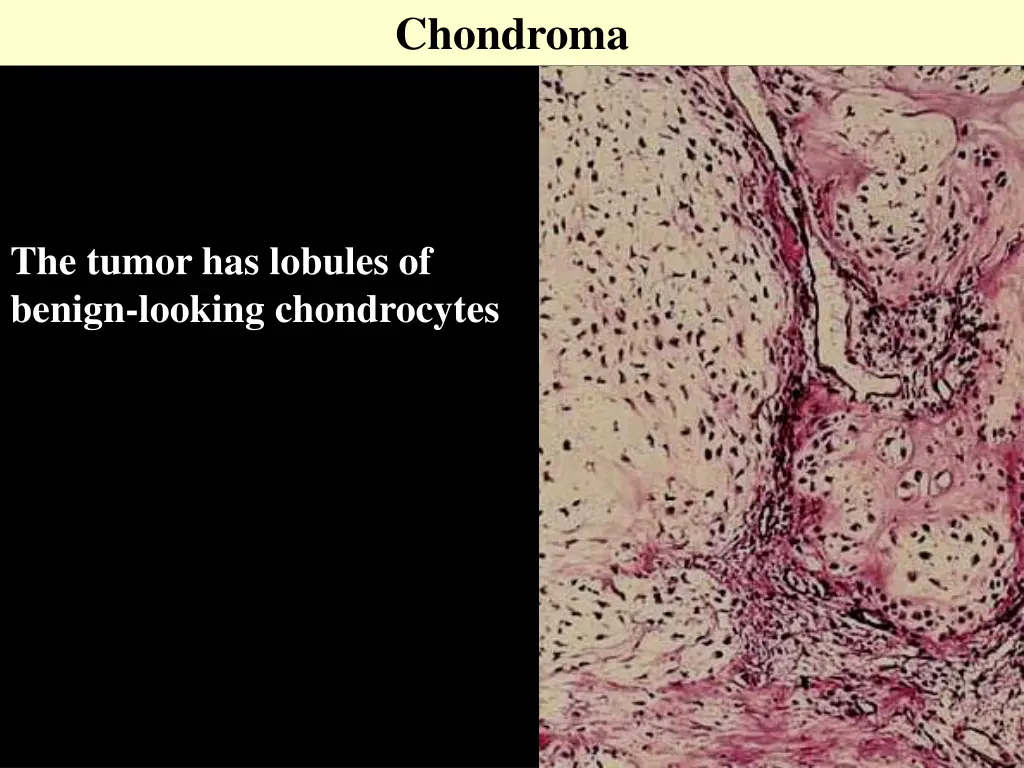 chondroma