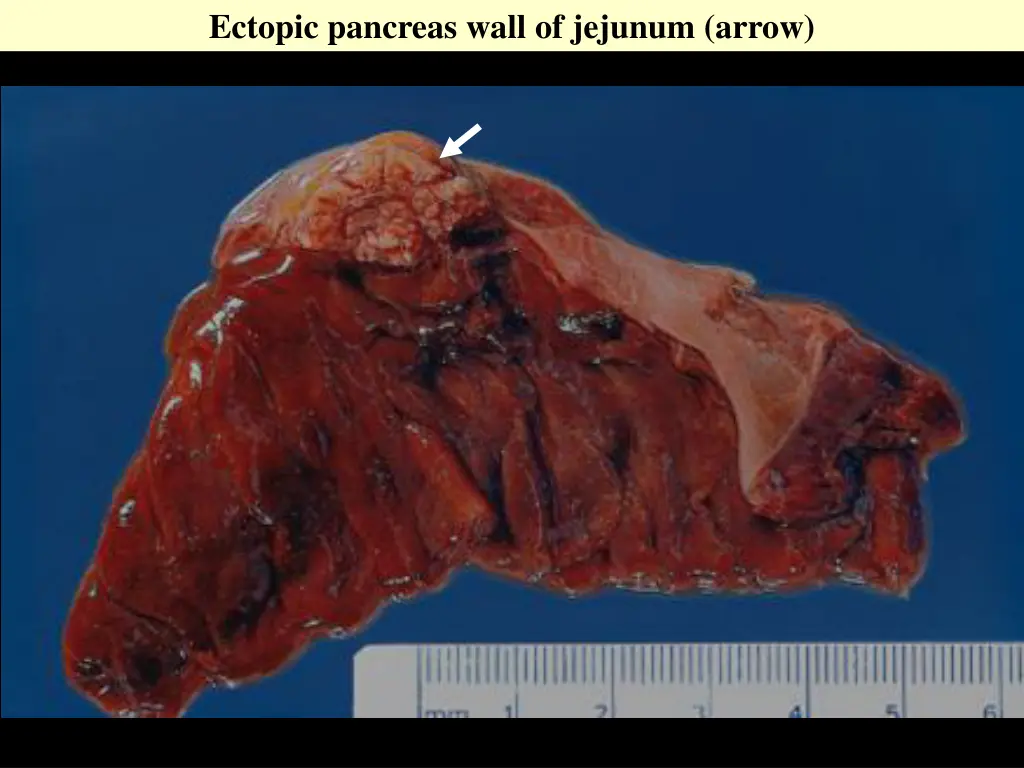 ectopic pancreas wall of jejunum arrow