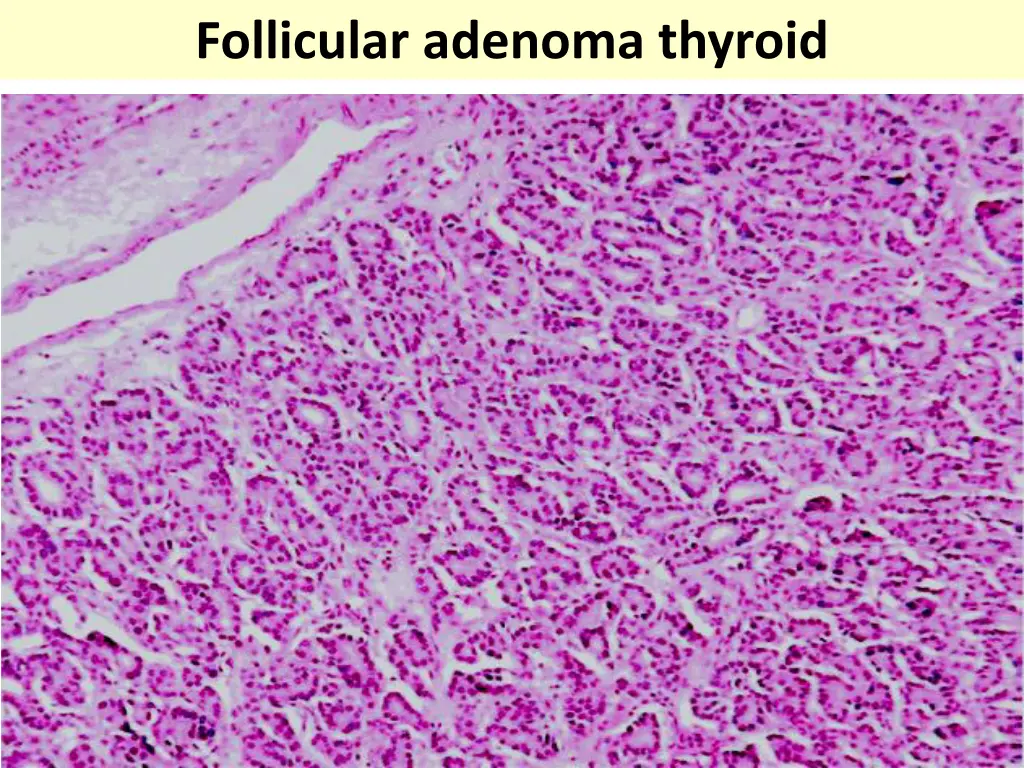 follicular adenoma thyroid