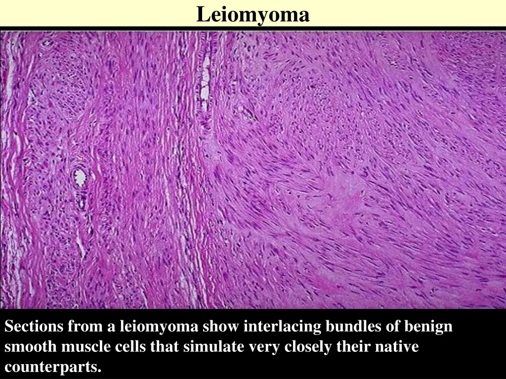 leiomyoma