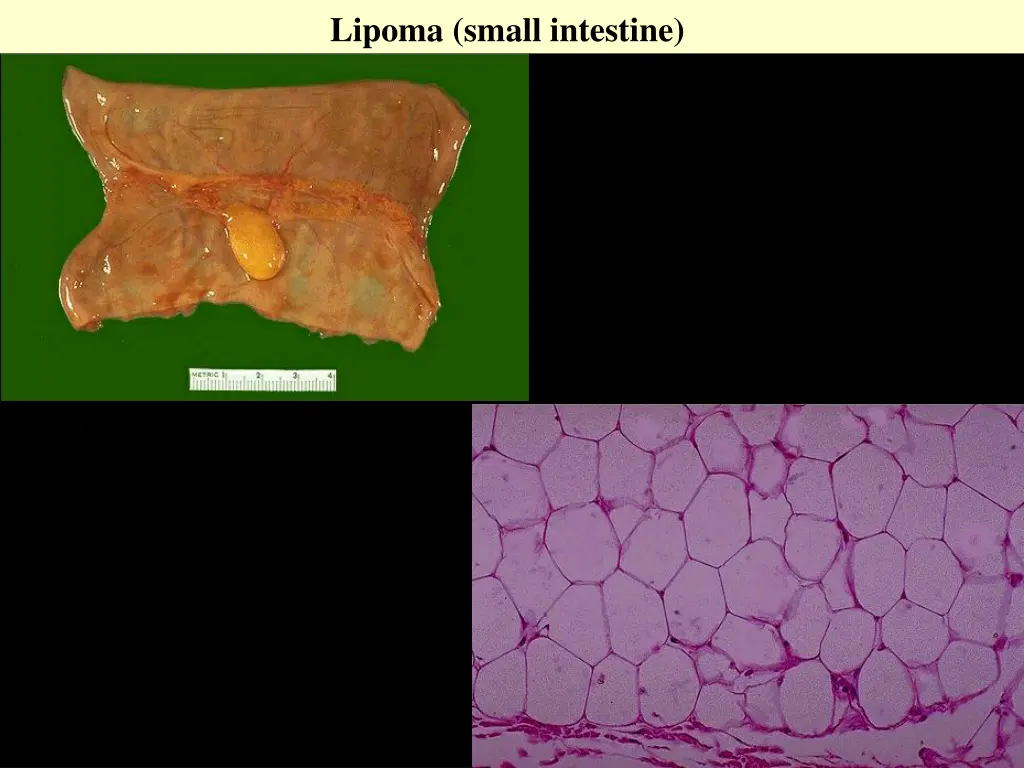 lipoma small intestine