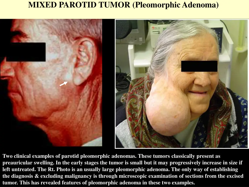 mixed parotid tumor pleomorphic adenoma