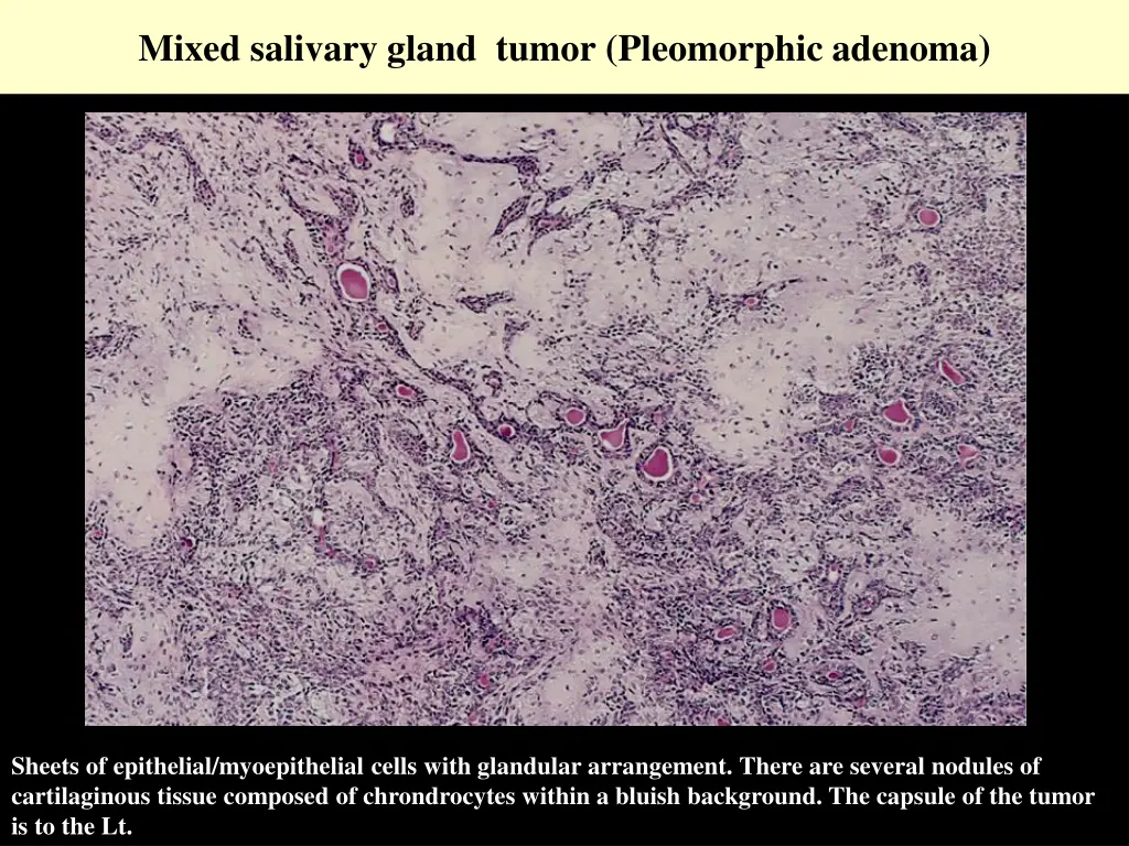 mixed salivary gland tumor pleomorphic adenoma