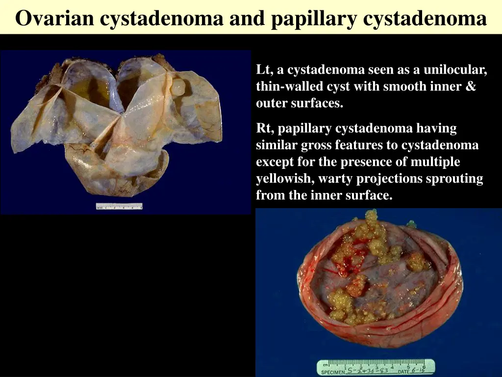 ovarian cystadenoma and papillary cystadenoma