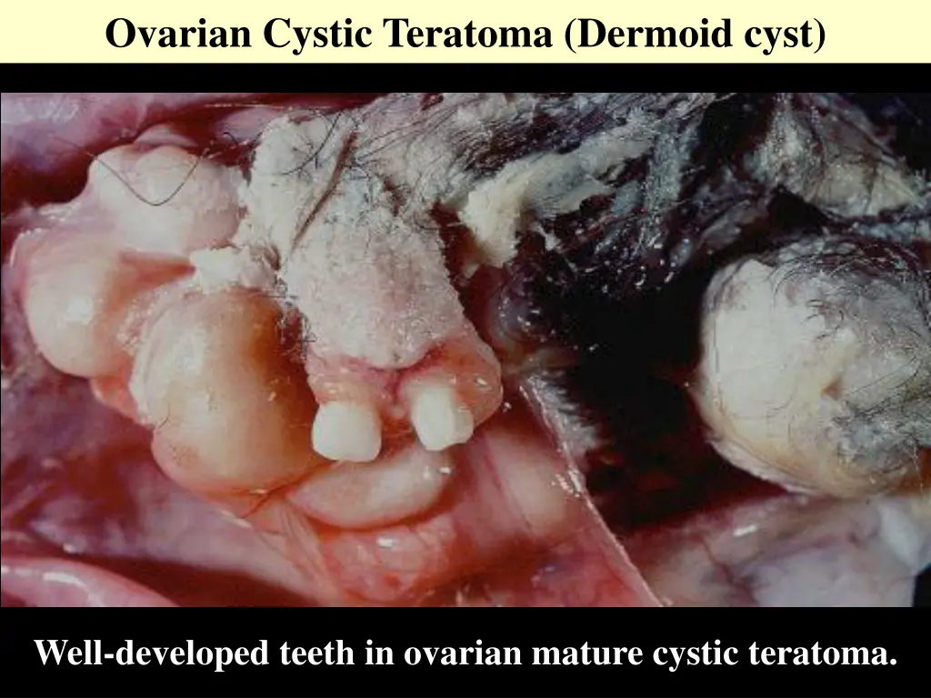 ovarian cystic teratoma dermoid cyst