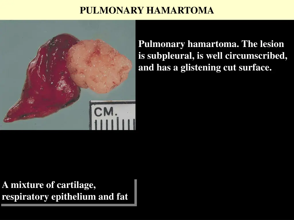 pulmonary hamartoma