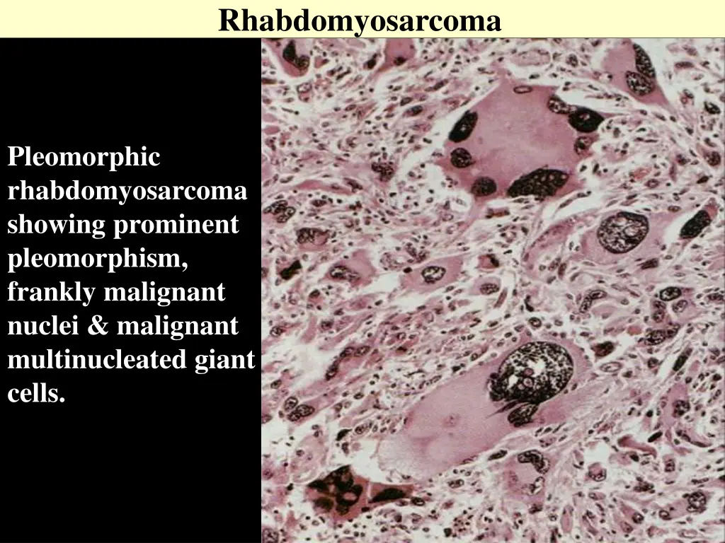 rhabdomyosarcoma