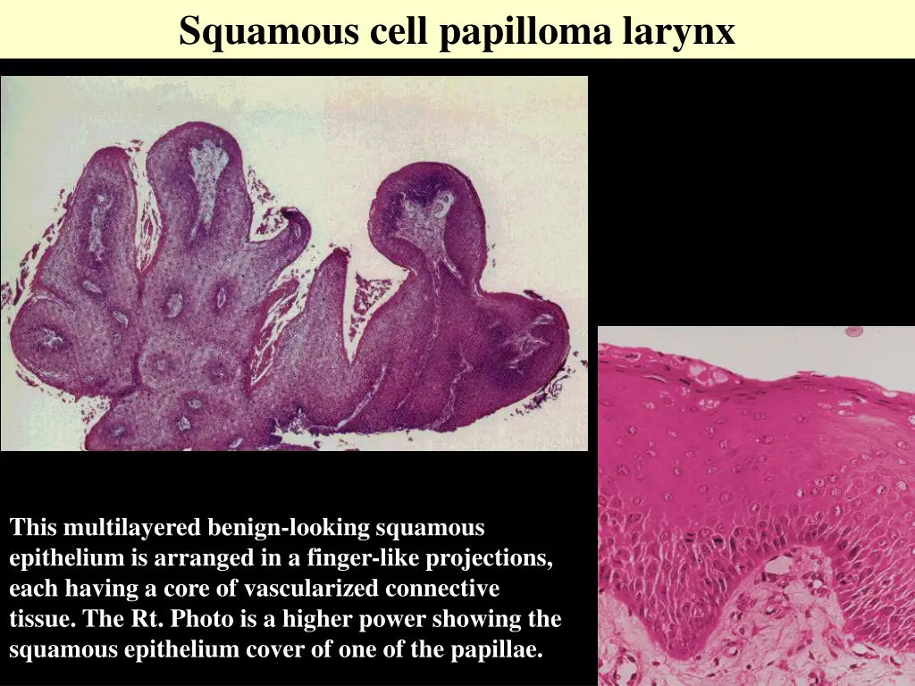 squamous cell papilloma larynx