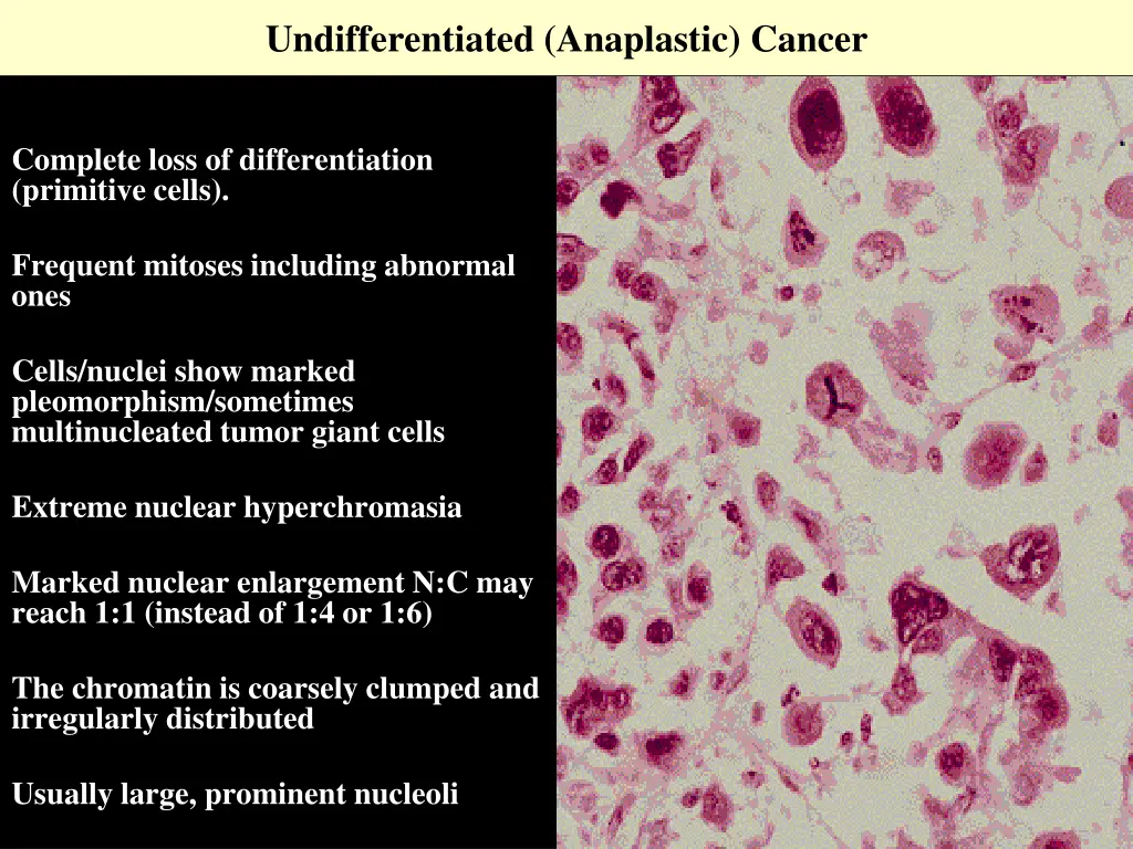 undifferentiated anaplastic cancer