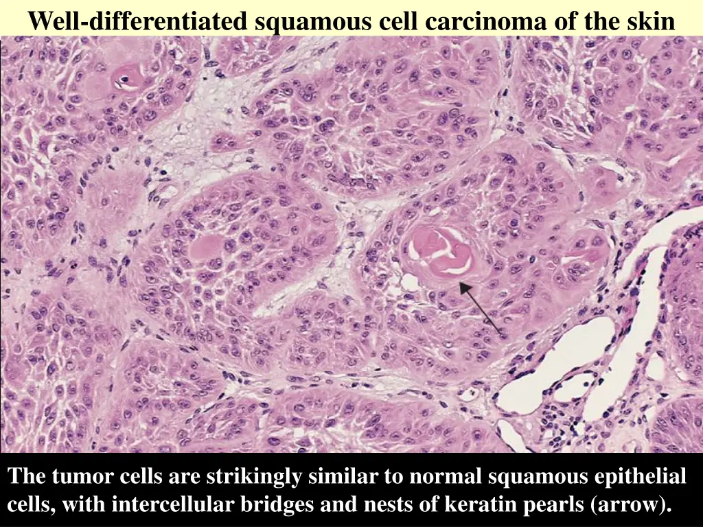 well differentiated squamous cell carcinoma