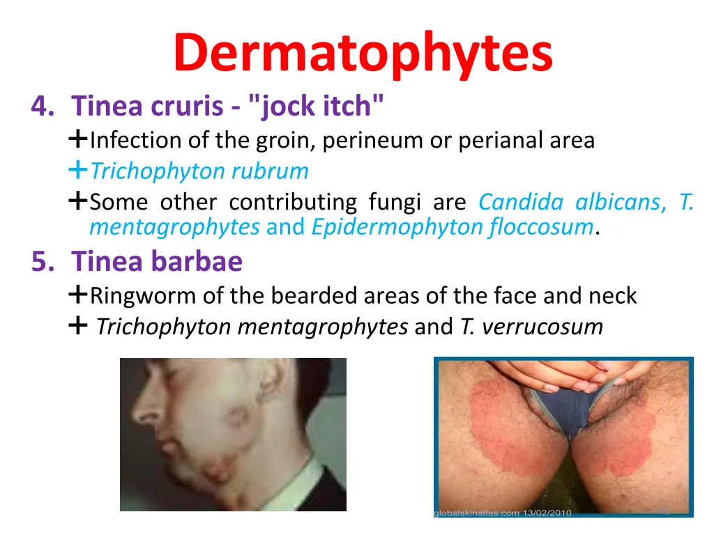 dermatophytes 4 tinea cruris jock itch infection