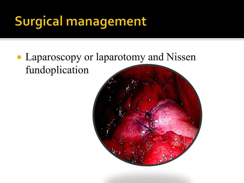 laparoscopy or laparotomy and nissen