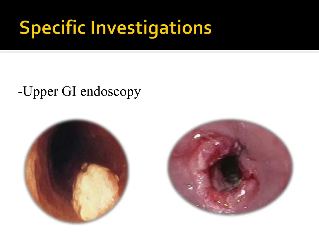 upper gi endoscopy