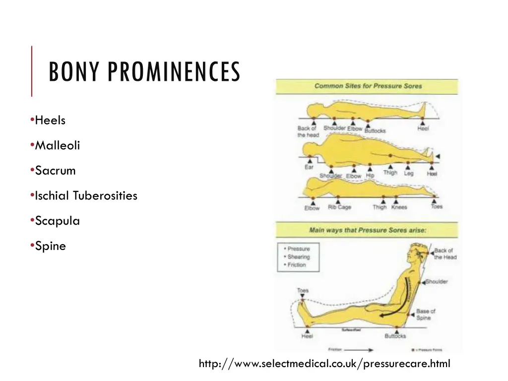 bony prominences