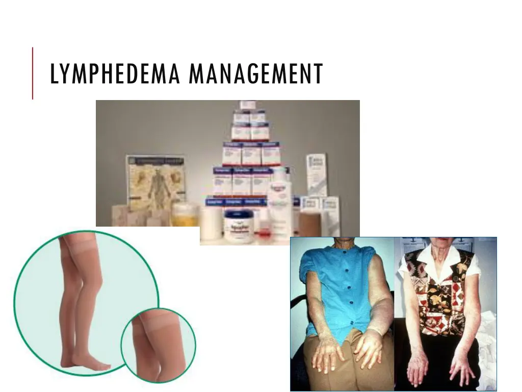 lymphedema management