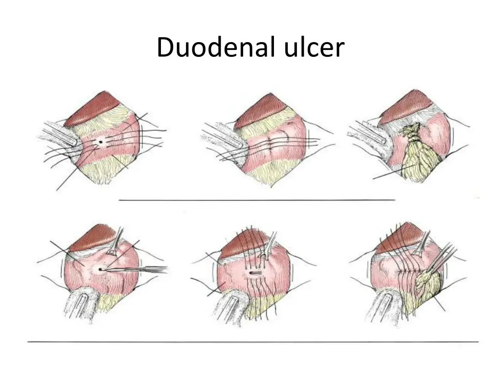 duodenal ulcer