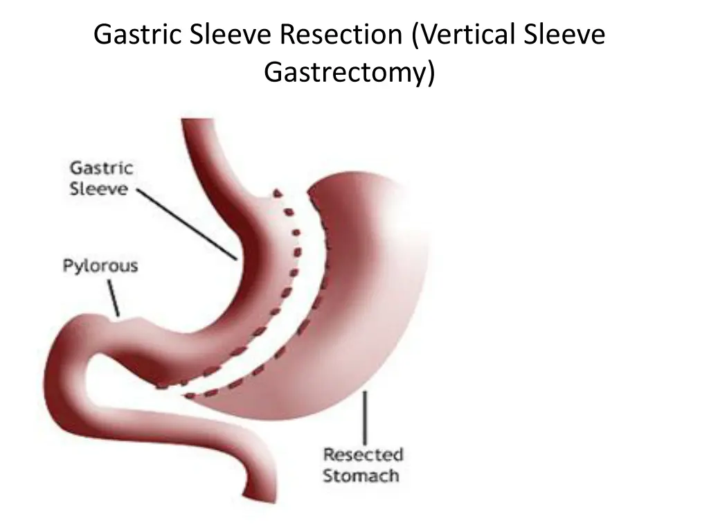 gastric sleeve resection vertical sleeve