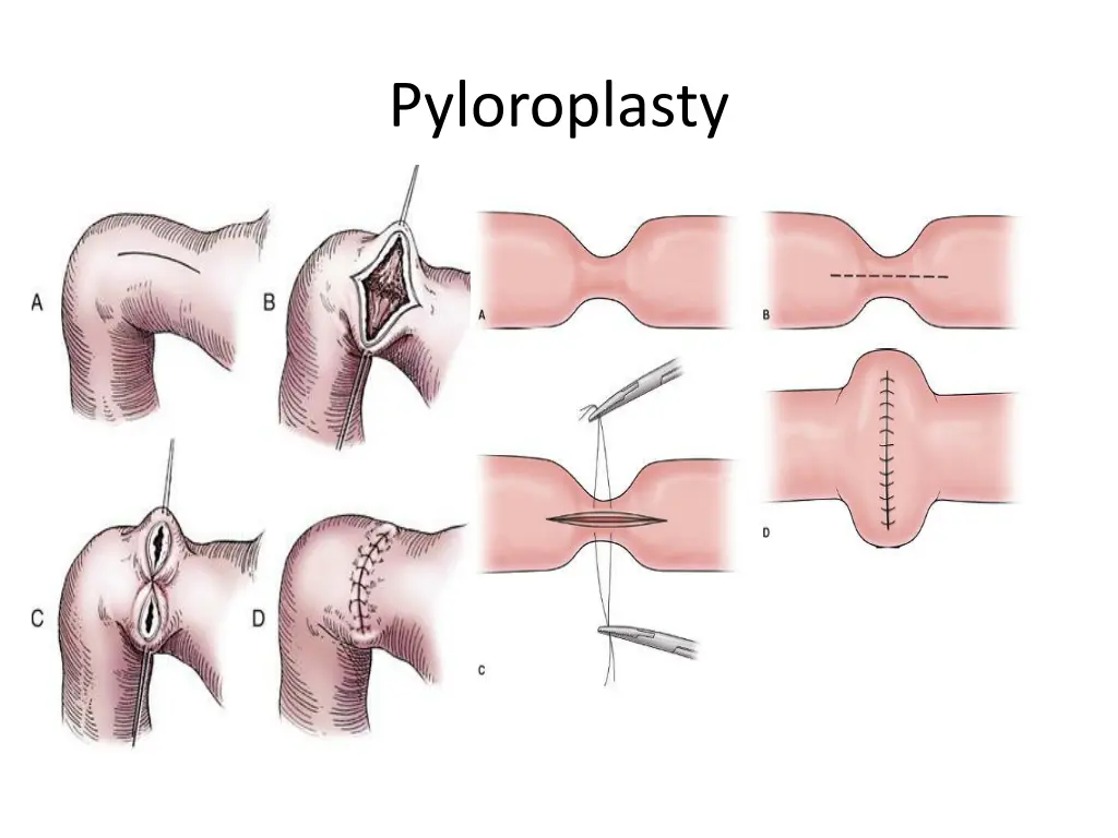 pyloroplasty