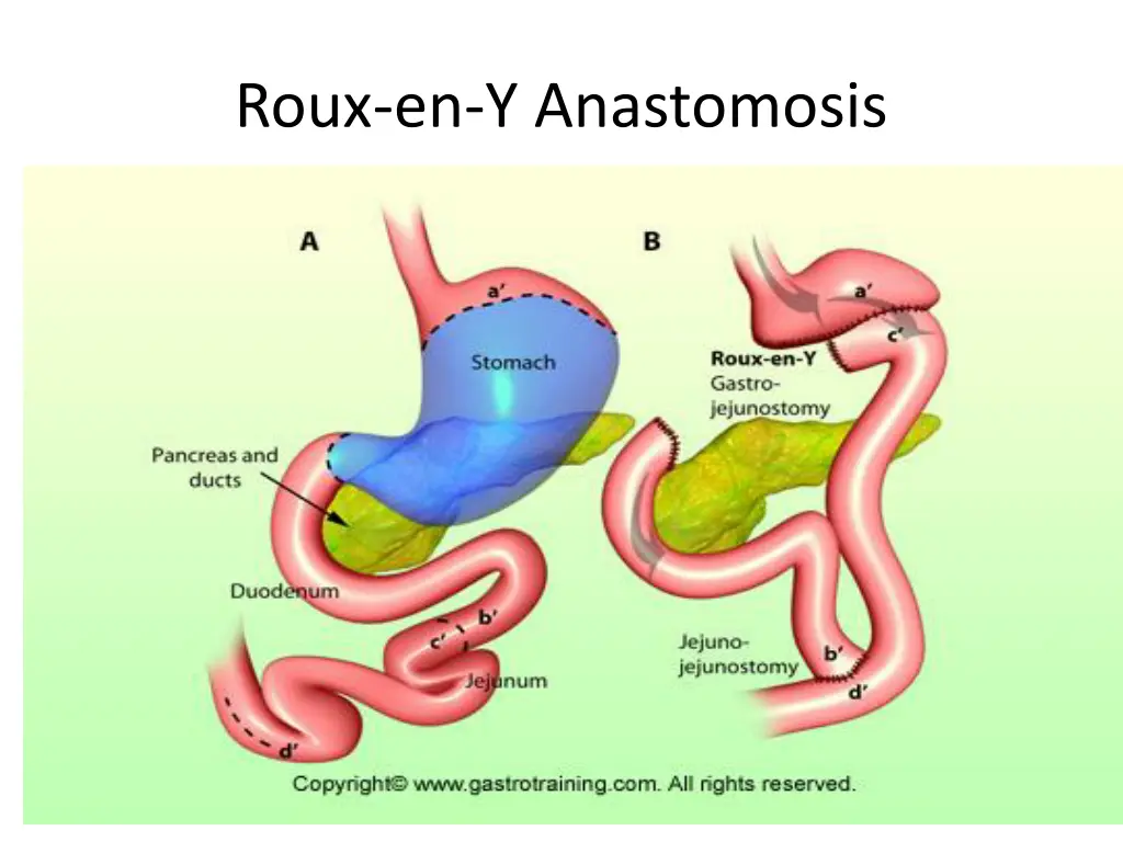 roux en y anastomosis