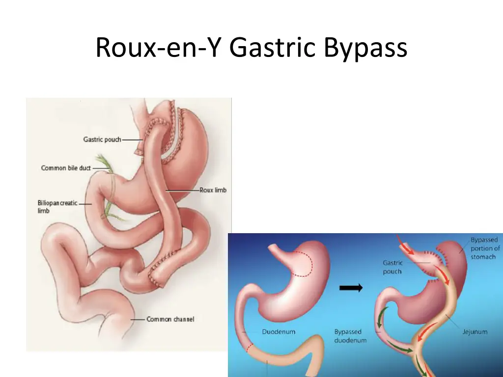 roux en y gastric bypass 1