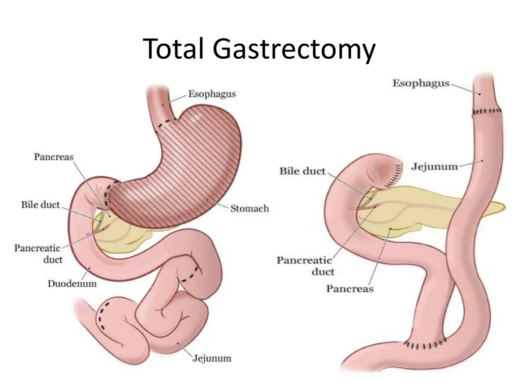 total gastrectomy