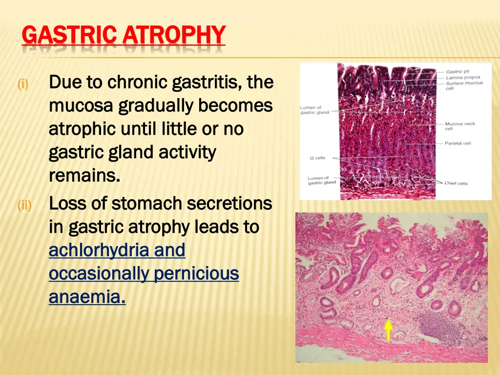 gastric atrophy gastric atrophy