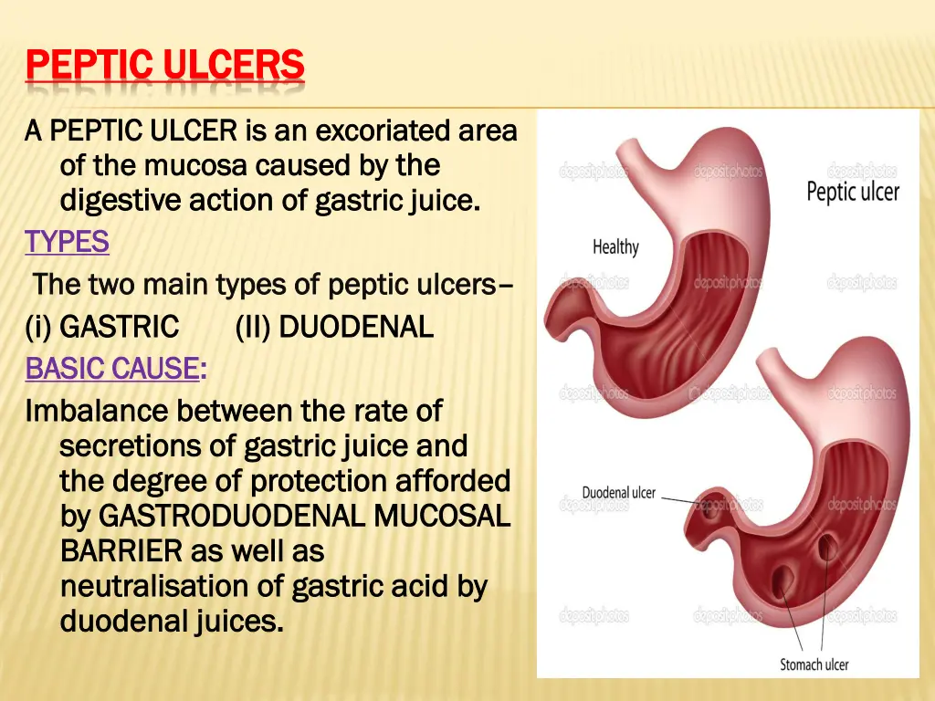 peptic ulcers peptic ulcers