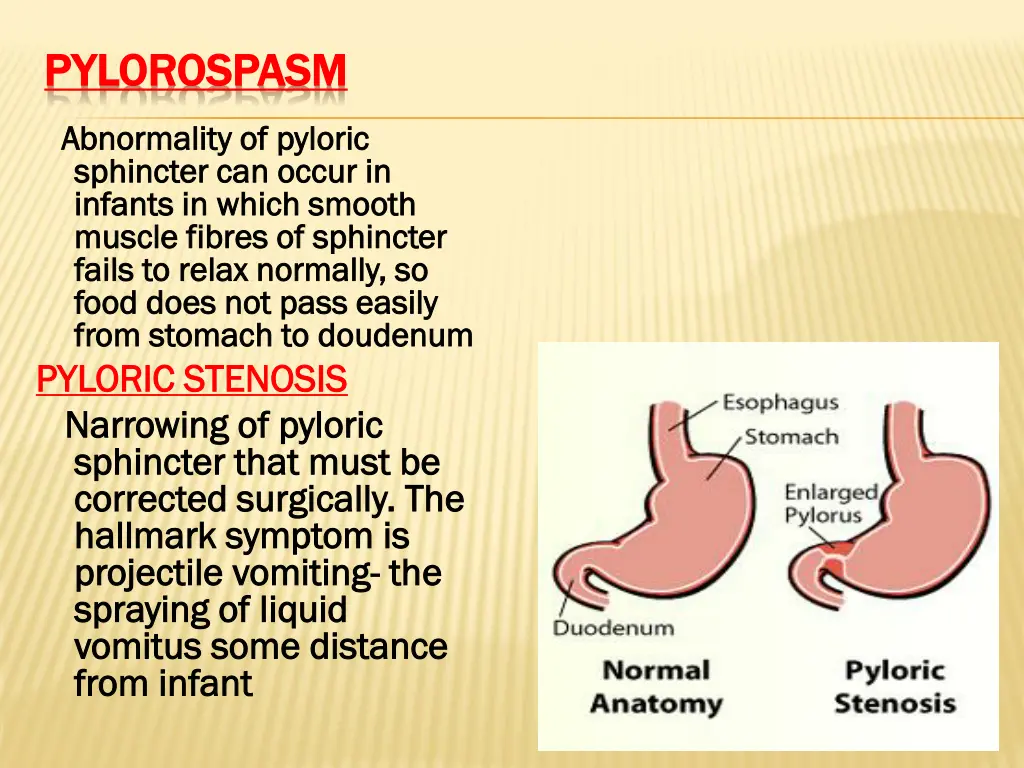 pylorospasm pylorospasm