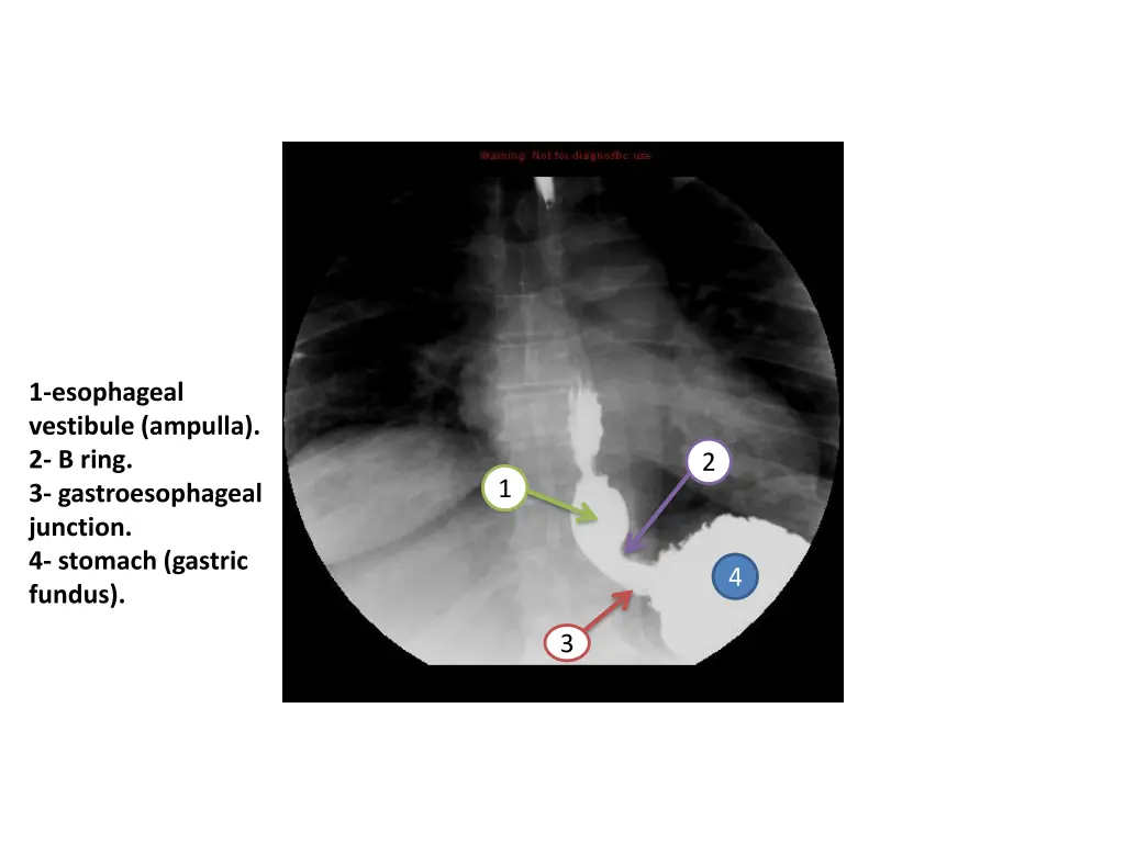 1 esophageal vestibule ampulla 2 b ring