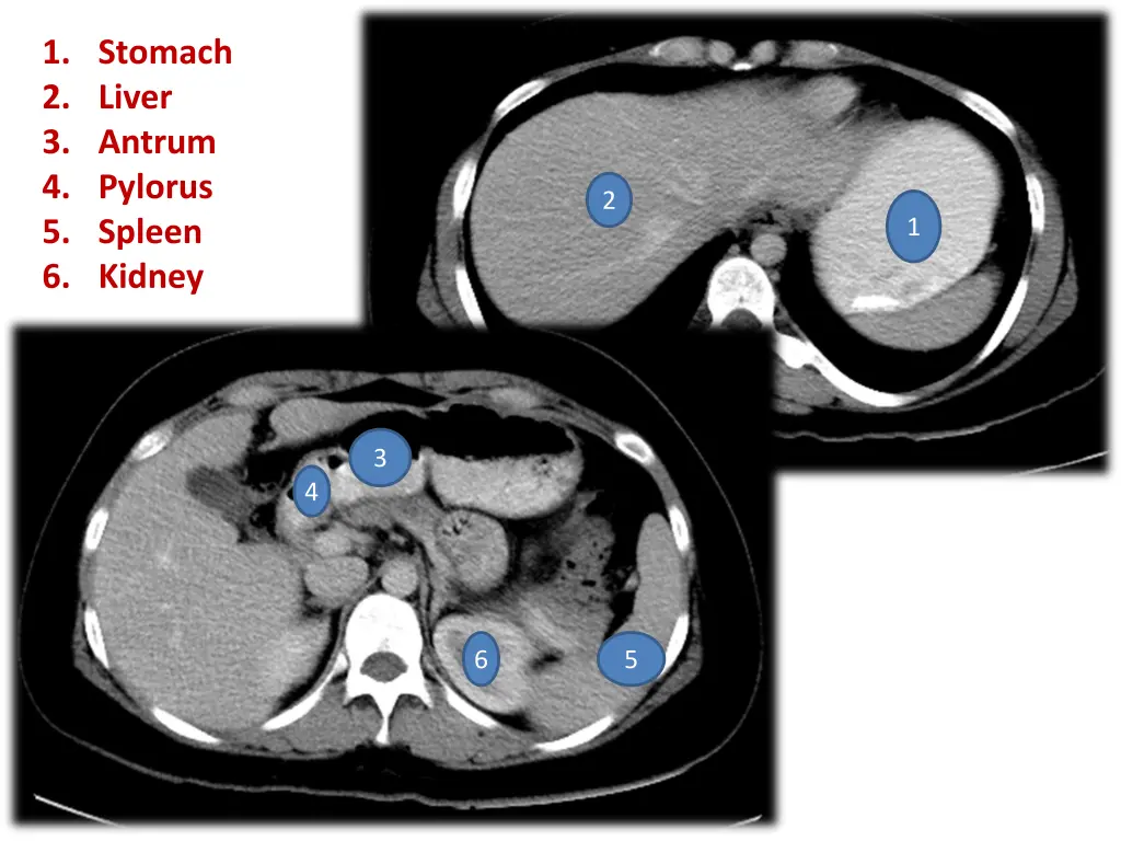 1 stomach 2 liver 3 antrum 4 pylorus 5 spleen