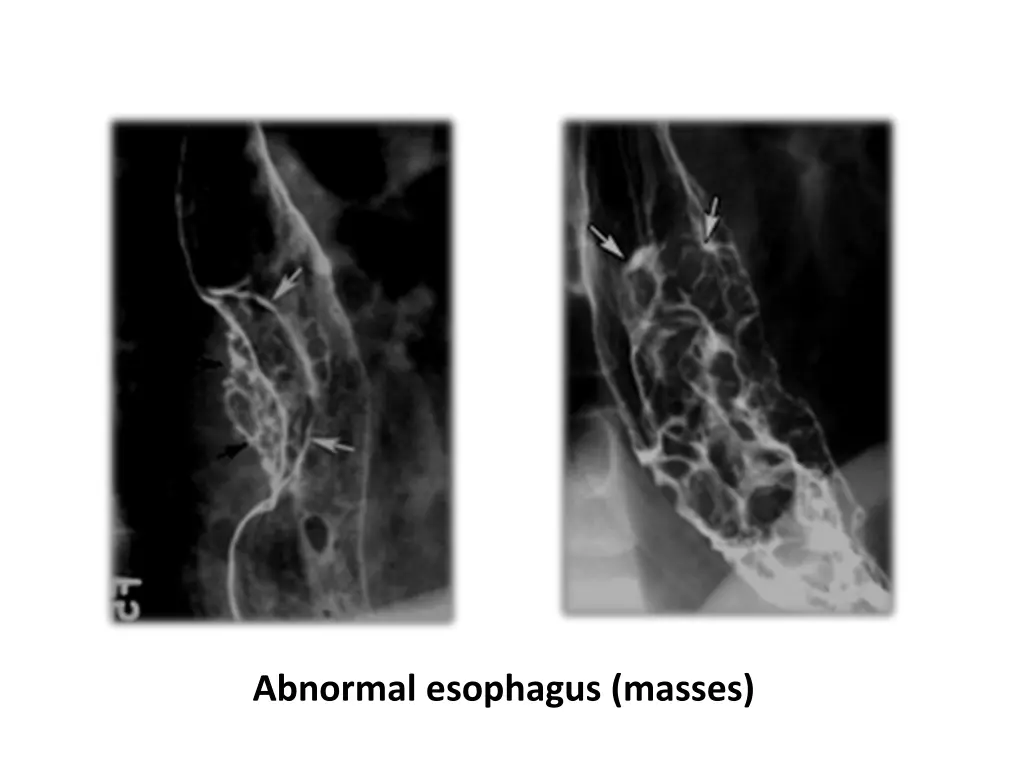 abnormal esophagus masses