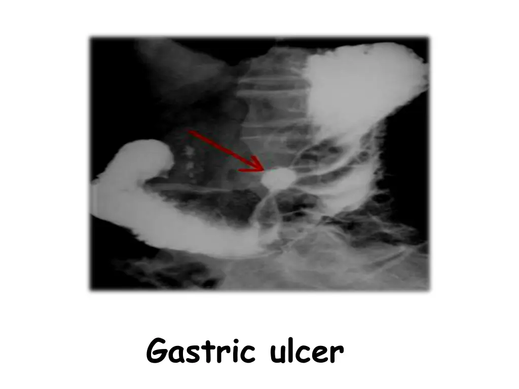 gastric ulcer