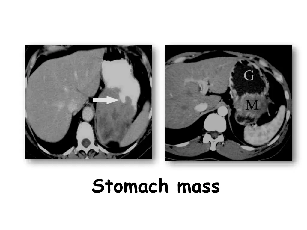 stomach mass