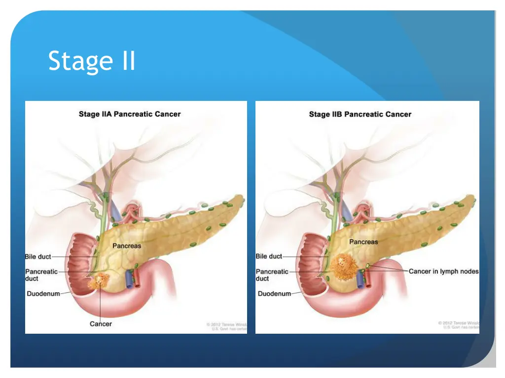 stage ii