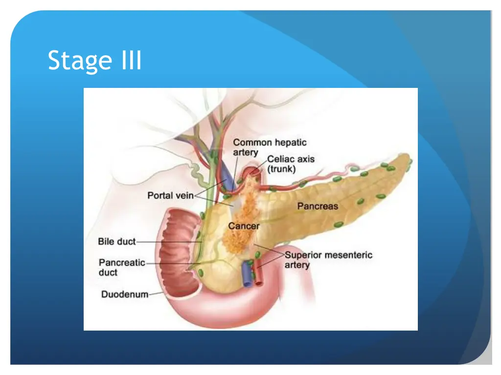 stage iii