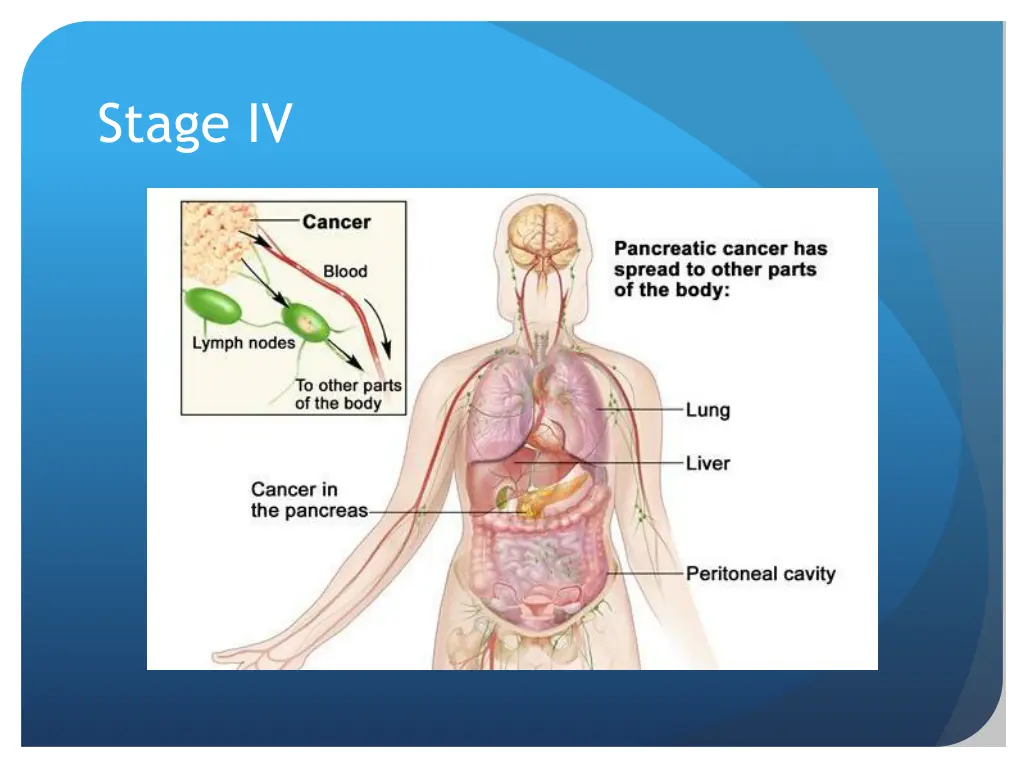 stage iv